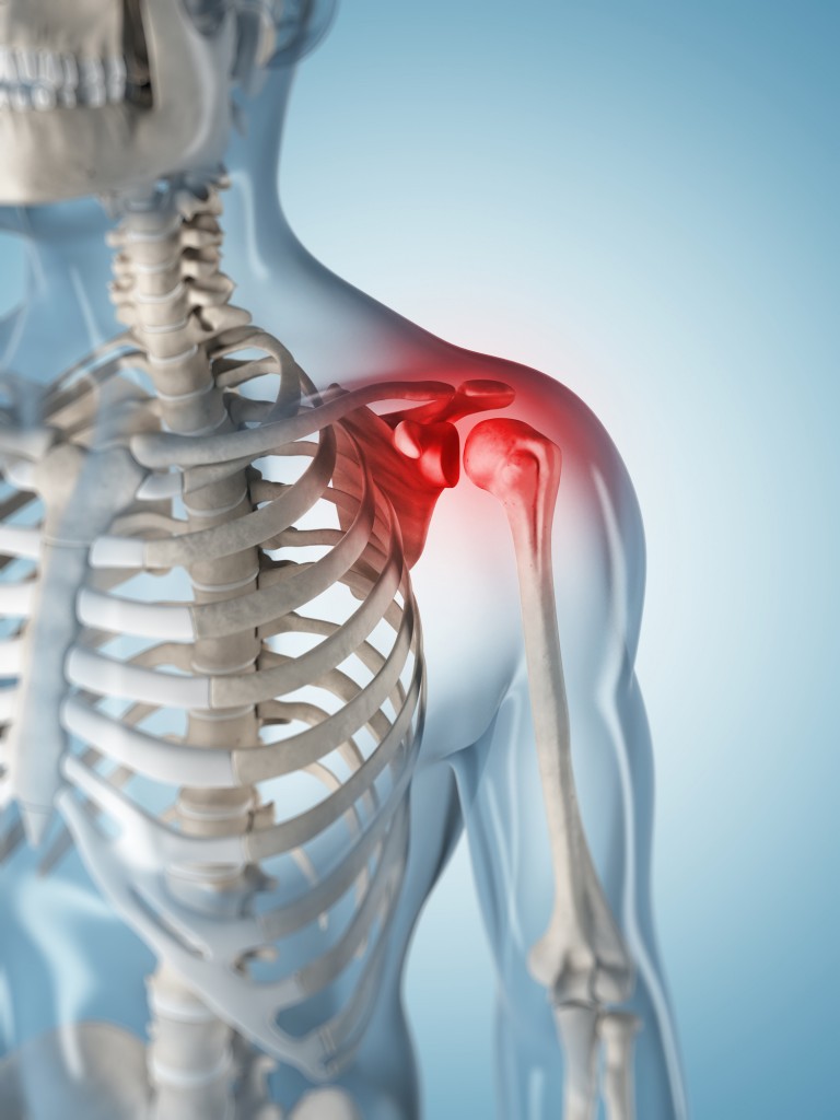 Frozen Shoulder - Bradford House Chiropractic Clinic