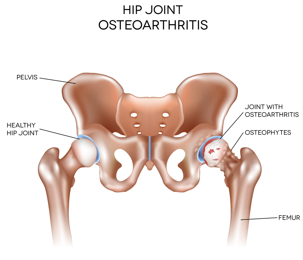 Osteoarthritis Of The Hip How Chiropractic May Help Bradford House 